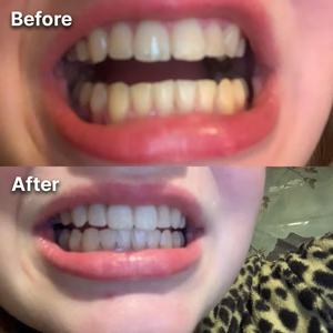 Purple Whitening Strips™