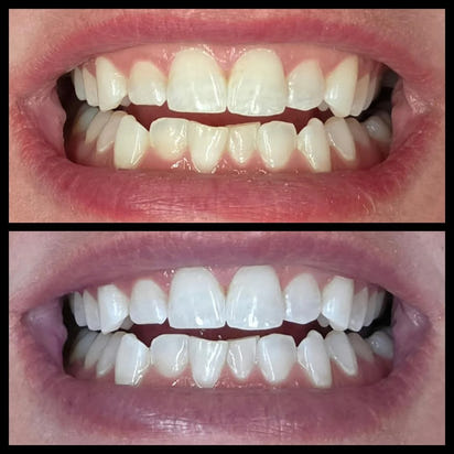 Purple Whitening Strips™