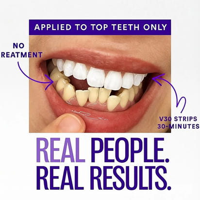 Purple Whitening Strips™